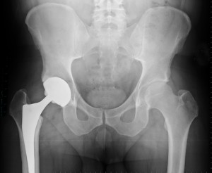 hip,implant,depuy,zimmer,biomet,r3,dorum,settlement,stryker,replacement, marcagoldich,stephenasheller,kimberlyaborden,christopheragomez,davidjacoby,samantharmertz,laurenasheller,priscillambrandon